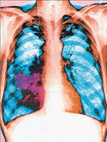 Με μια ανάσα θα εντοπίζεται εγκαίρως ο καρκίνος των πνευμόνων