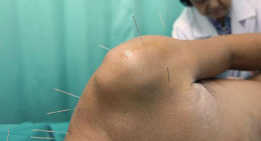 Βρήκαν πως λειτουργεί ο βελονισμός