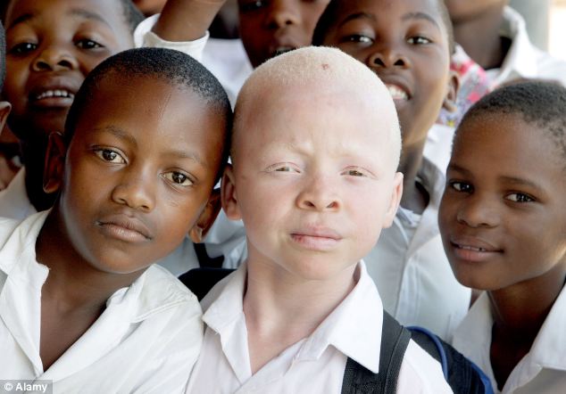 Τανζανία: Ακρωτηρίασαν αγόρι με αλμπινισμό, για να φτιάξουν απ’ το χέρι του… φυλαχτά