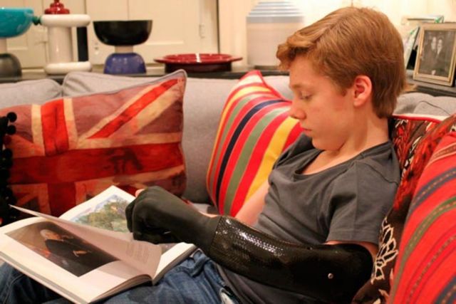 Βιονικό χέρι υψηλής ακρίβειας