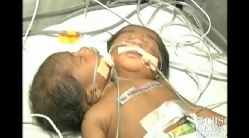 Παιδί με δύο κεφάλια γεννήθηκε στην Ινδία