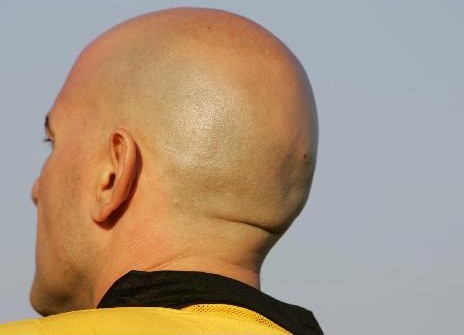 Η αρχή του τέλους για την φαλάκρα;