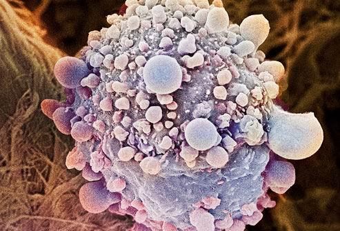 Νέα εξέταση ανιχνεύει τον καρκίνο σε λίγες ώρες