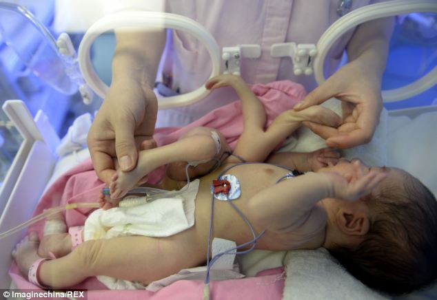 Μωρό με πολλαπλά άκρα γεννήθηκε στην Κίνα
