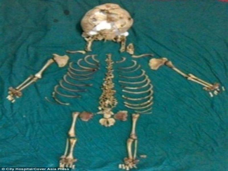Ινδοί γιατροί αφαίρεσαν σκελετό εμβρύου από την κοιλιά της μητέρας 36 χρόνια μετά