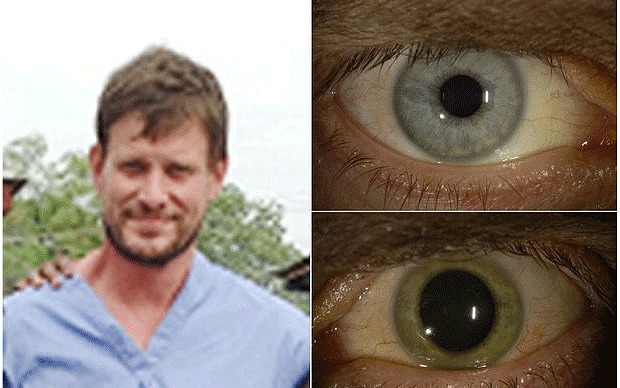 Θεραπεύτηκε από τον Εμπολα και μετά από δυο μήνες είδε το μάτι του να αλλάζει χρώμα