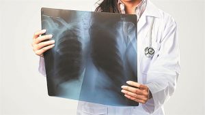 Πρόληψη για τον καρκίνο του πνεύμονα