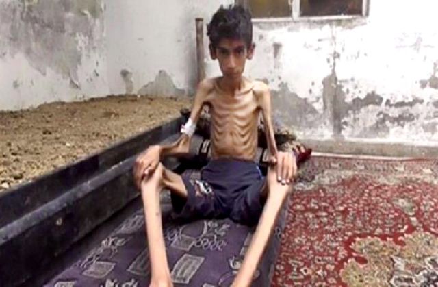 ΟΗΕ: Είδαμε ακραίως υποσιτισμένα παιδιά στην Μαντάγια της Συρίας