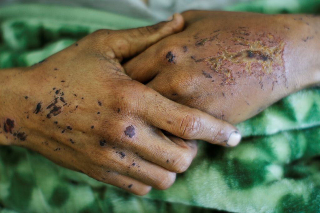Εννέα νεκροί από χολέρα στην Υεμένη