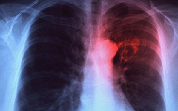 Επανεμφάνιση της φυματίωσης στην Ελλάδα λόγω πτώσης του βιοτικού επιπέδου