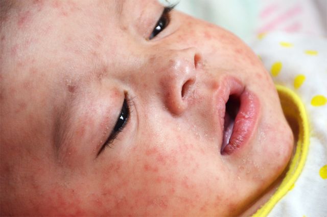 Επιδημία ιλαράς στην Ευρώπη, κανένα κρούσμα στην Ελλάδα