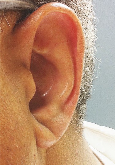 Οι λοβοί των αυτιών «προδίδουν» το εγκεφαλικό