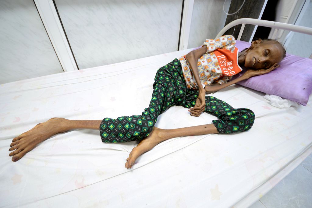 ΟΗΕ: «Σοκαριστική» η κατάσταση στην Υεμένη