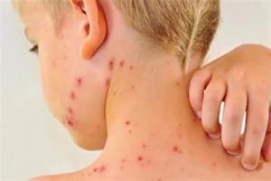 Στα 1.262 τα κρούσματα ιλαράς στην Ελλάδα