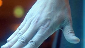 Σύστημα τεχνητής νοημοσύνης στη μάχη για τον καρκίνο του δέρματος