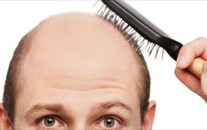 Θεραπεία στη φαλάκρα υπόσχεται φάρμακο για την οστεοπόρωση