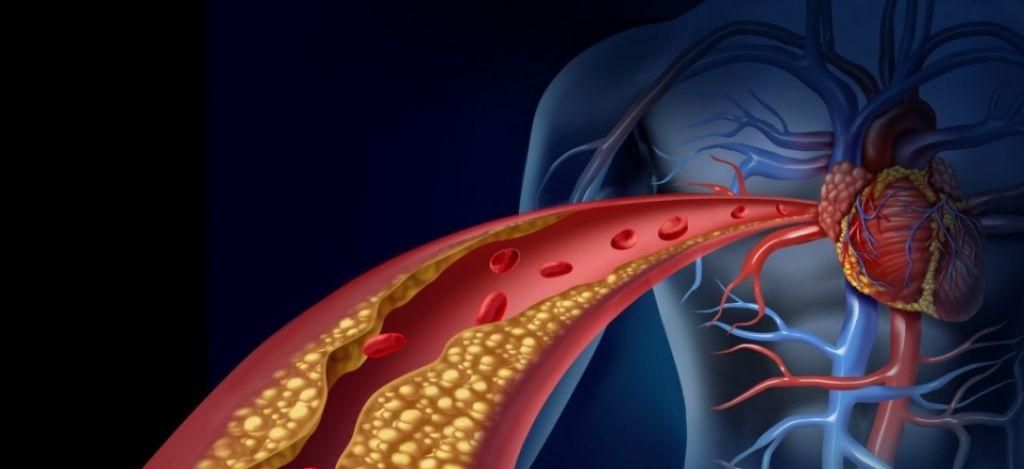 Νέα θεραπεία αναστρέφει την αθηροσκλήρωση