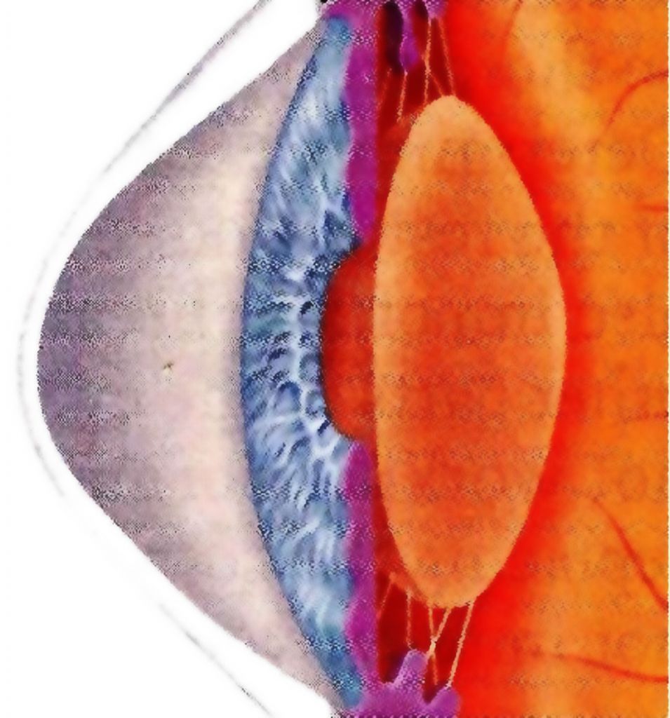 Νέος τρόπος αντιμετώπισης εκφυλιστικών παθήσεων του κερατοειδούς