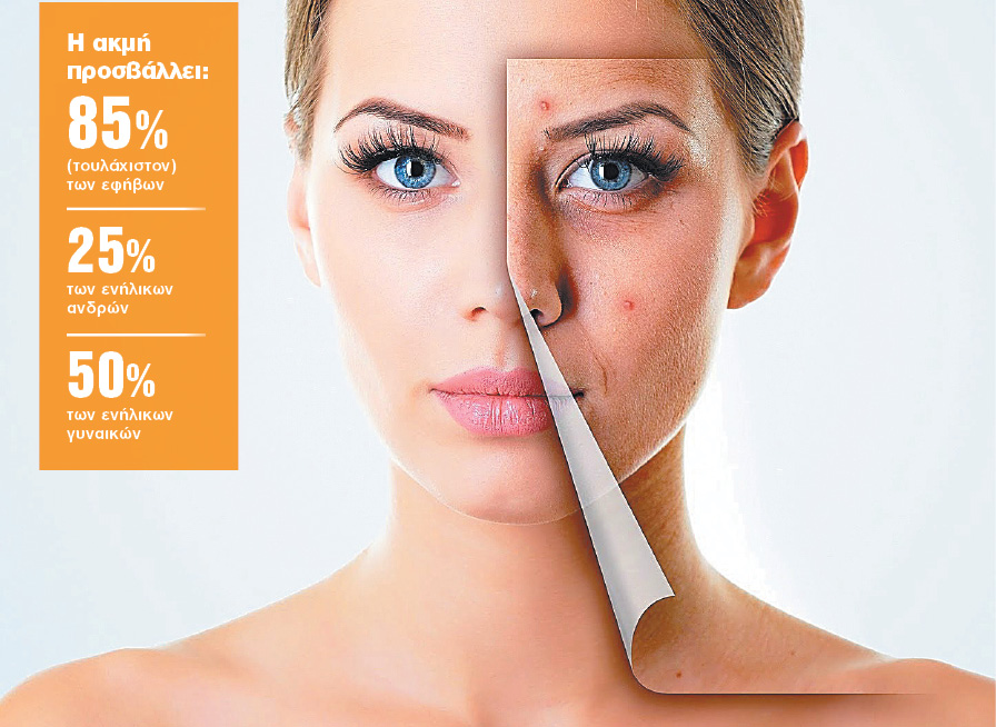 Η ακμή χρόνια δεν κοιτά!