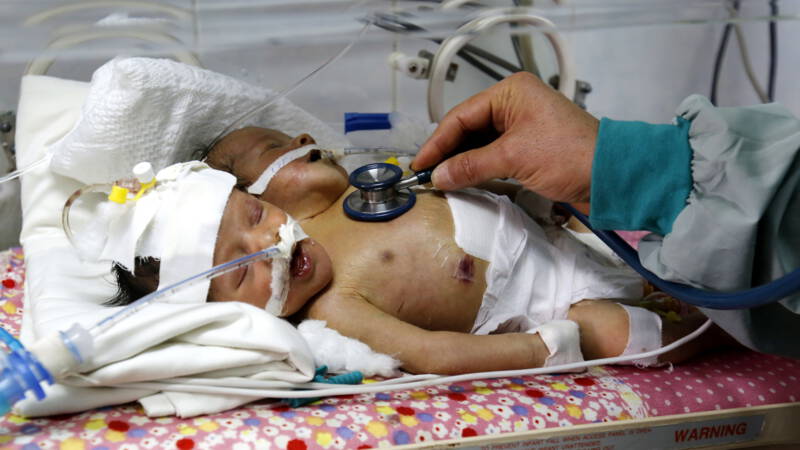 Εχασαν τη μάχη με τη ζωή τα σιαμαία βρέφη που νοσηλεύονταν στην Υεμένη