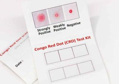 Τεστ ούρων ανιχνεύει την προεκλαμψία σε τρία λεπτά