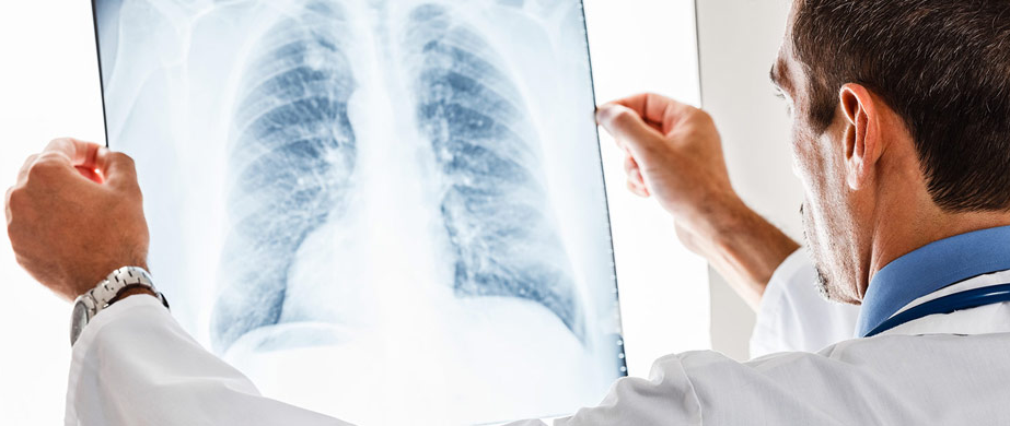 Σύστημα τεχνητής νοημοσύνης ανιχνεύει τον καρκίνο του πνεύμονα καλύτερα από τους ακτινολόγους