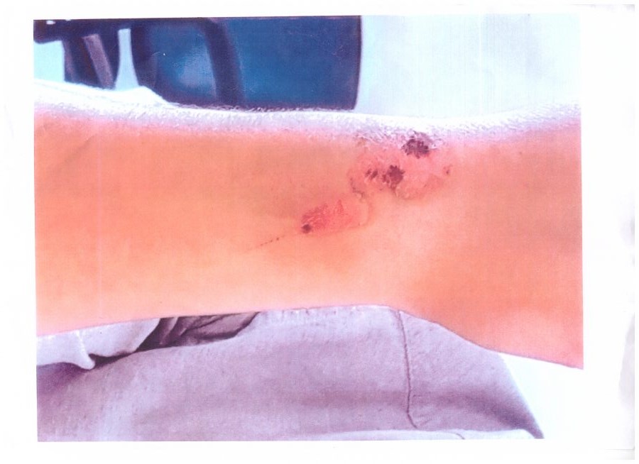 Κέρκυρα: Βασάνιζαν με καυτό λάδι σπουδαστή μαγειρικής σε εστιατόριο