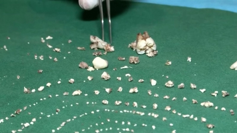 Επτάχρονος είχε στο στόμα του σάκο με 526 δόντια (βίντεο)