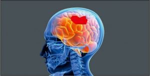 Εγκεφαλικό : Πώς θα μειώσετε τον κίνδυνο εμφάνισης