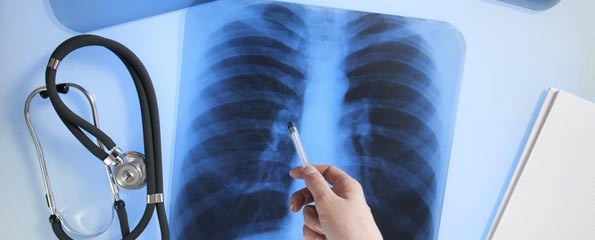 Καρκίνος του πνεύμονα: 7.000 νέες περιπτώσεις τον χρόνο στην Ελλάδα