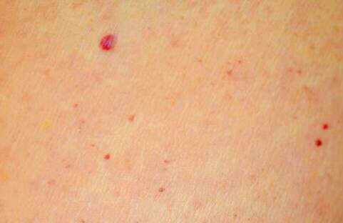 Κόκκινες ελιές στο δέρμα : Μην τις αγνοείτε