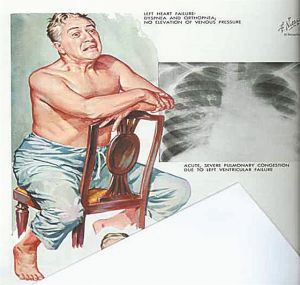 Αντιμετώπιση της ίωσης από ασθενείς με καρδιοπάθεια