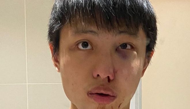 «Δεν θέλω τον κορωνοϊό σου» του είπε και μετά τον ξυλοκόπησε άγρια