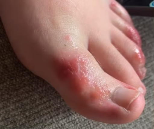 Covid toe : Τι είναι το δυσάρεστο σύμπτωμα που εμφανίζουν κάποιοι ασθενείς