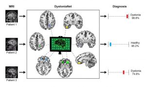 Διάγνωση της δυστονίας σε κλάσματα του δευτερολέπτου από αμερικανικό σύστημα ΤΝ