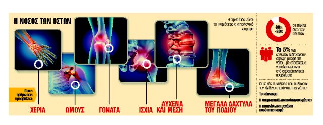 Η «ακτινογραφία» της αρθρίτιδας