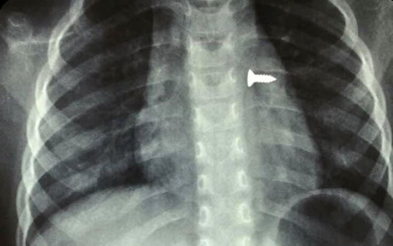 Κρήτη: Τρίχρονο κοριτσάκι κατάπιε βίδα που κατέληξε στον αριστερό της πνεύμονα
