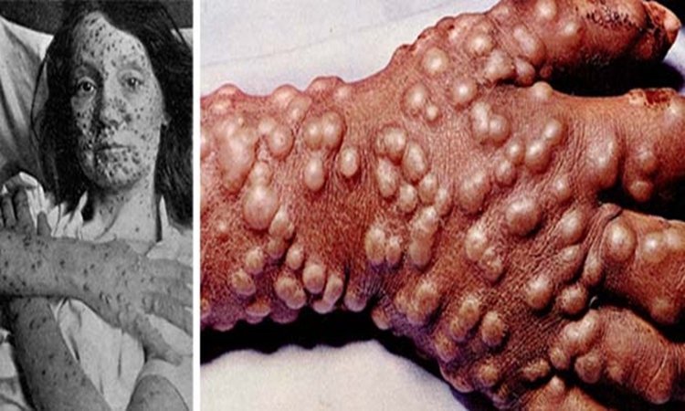 Γιατί είναι απαραίτητος ο καθολικός εμβολιασμός για τον κοροναϊό  – Το παράδειγμα της ευλογιάς