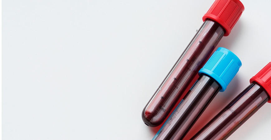 Τα επίπεδα νατρίου δείχνουν ποιοι ασθενείς κινδυνεύουν περισσότερο