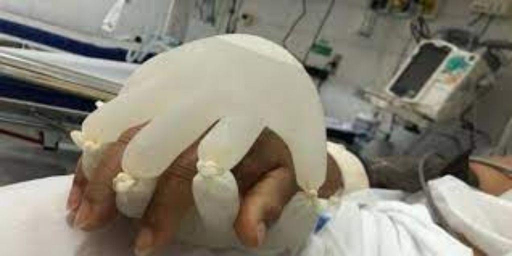Γάντια γεμάτα με ζεστό νερό «κρατάνε» το χέρι των ασθενών