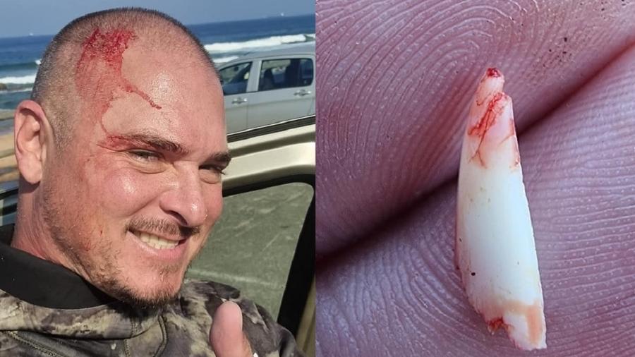 Δύτης βγάζει δόντι καρχαρία από το κρανίο του μετά από επίθεση