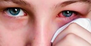 Δεκάλογος για την αποφυγή της εαρινής επιπεφυκίτιδας