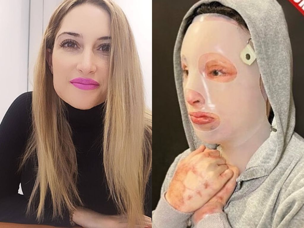 Επίθεση με βιτριόλι: Η κατάσταση της υγείας της Ιωάννας μετά το 8ο χειρουργείο