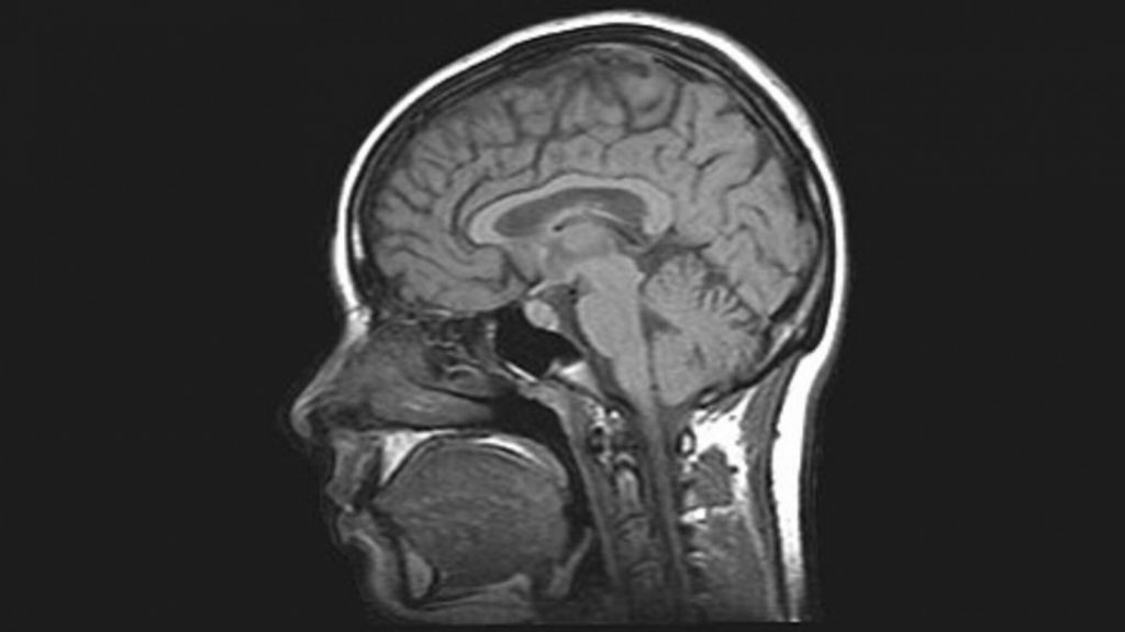 Κοροναϊός – Μελέτη δείχνει εγκεφαλικές βλάβες στο 1% των ασθενών που χρειάζονται νοσηλεία