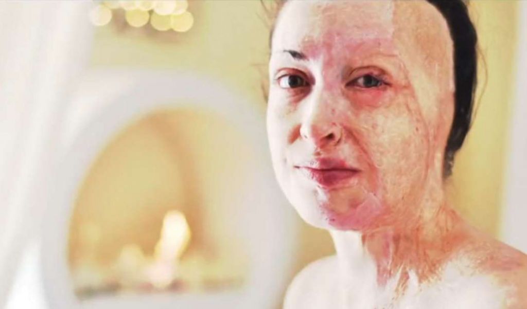 Ιωάννα Παλιοσπύρου: Eδειξε το πρόσωπό της και περιέγραψε τις δραματικές στιγμές της επίθεσης με βιτριόλι