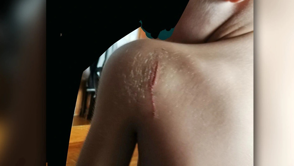 Συγκλονίζει ο 11χρονος που μαχαίρωσαν στον Εύοσμο: Χθες με χτύπησαν ξανά