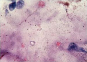 Πάτρα: Γυναίκα με λέπρα νοσηλεύεται στο πανεπιστημιακό νοσοκομείο στο Ρίο