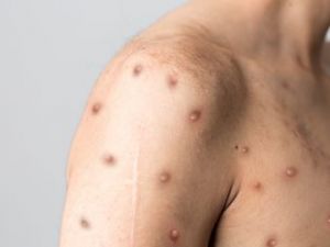 Ευλογιά των πιθήκων: Παγκόσμιο συναγερμό κήρυξε ο ΠΟΥ