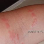 Μωβ μέδουσες: Η διπλή επίθεση σε γυναίκα που κολυμπούσε στα Χανιά