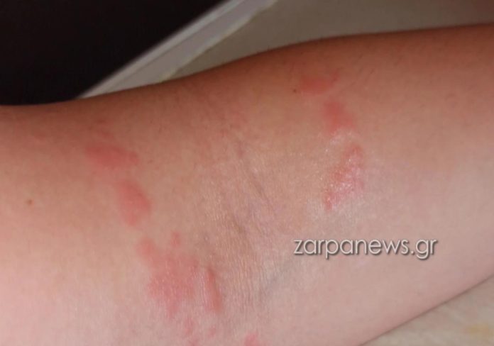 Μωβ μέδουσες: Η διπλή επίθεση σε γυναίκα που κολυμπούσε στα Χανιά